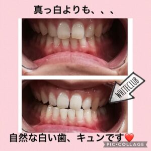 歯のホワイトニング=歯のエイジングケア! お肌のお手入れと一緒に是非!